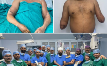 Delhi painter get Hands back as organ donation meets surgical excellence